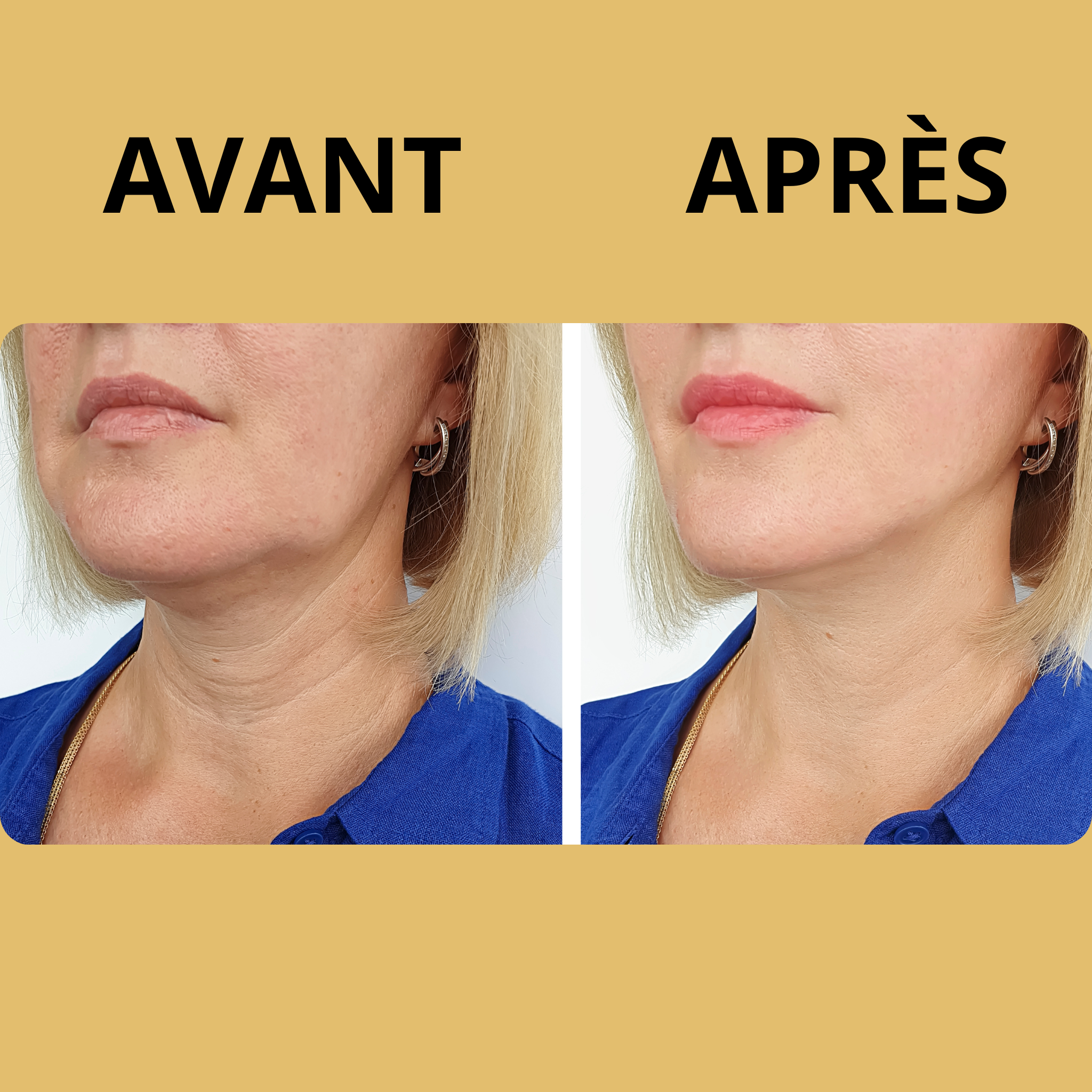 Zoumy™ | Lèvres Sublimes au Naturel